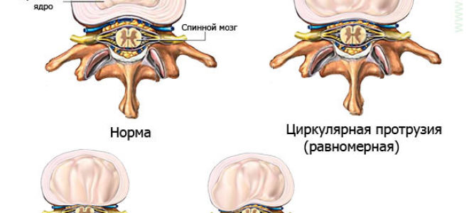 Циркулярная протрузия межпозвонковых дисков: что это значит и стоит ли волноваться, симптомы, разновидности и способы лечения патологии