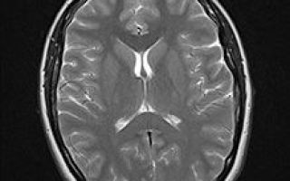 Кожевниковская (корковая) эпилепсия: причины, лечение, особенности припадков