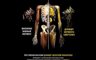 Остеонекроз: заболевания костей, суставов и мышц, причины заболевания, симптомы и способы лечения