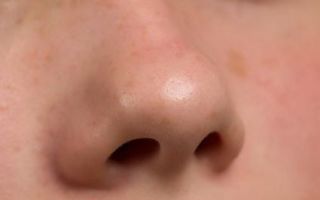 Перелом носа: классификация и отличительные симптомы травмы, правила оказания первой помощи и особенности лечения, последствия и реабилитация