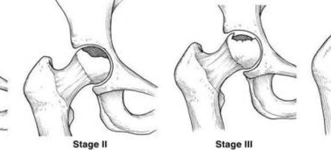 Лечение асептического некроза головки плечевой кости: механизм развития заболевания, признаки, особенности диагностики, терапия и профилактика