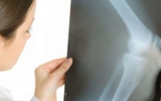 Остеосинтез при переломе кости: виды, показания и противопоказания метода, техника операции, осложнения после