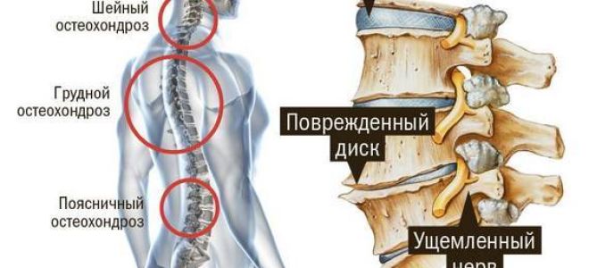 Инвалидность при остеохондрозе поясничного и шейного отделов: обследования к прохождению, рекомендации к оформлению нетрудоспособности, общие правила и требования