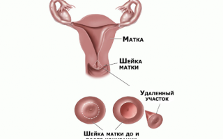 Симптомы рака шейки матки на ранней стадии