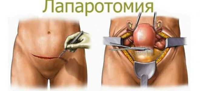 Лопнула гигрома: причины формирования и разрыва кист, первая помощь и методы лечения, профилактика осложнений и прогноз для жизни