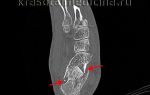 Перелом пяточной кости: классификация и симптомы травмы, диагностика и правила оказания первой помощи, сроки иммобилизации и методы лечения, реабилитационный период