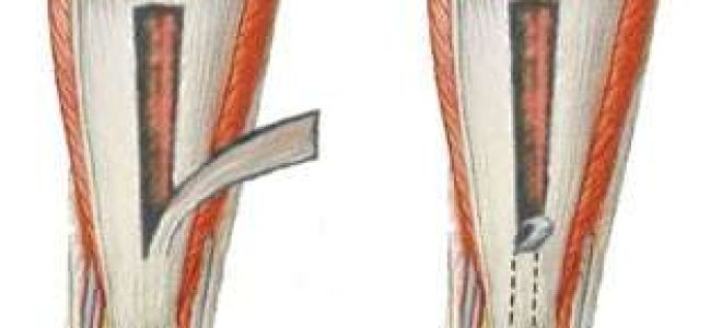 Разрыв ахиллова сухожилия: фото до и после, операция, отзывы пациентов, хирургическое и медикаментозное лечение