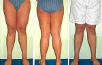 Вальгусная деформация коленных суставов с фото: причины и симптомы, диагностика и 4 методики лечения, возможные осложнения