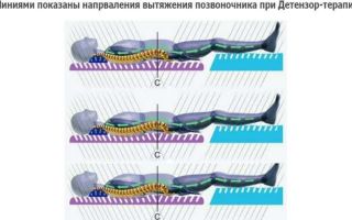 Физиотерапия при грыже поясничного отдела позвоночника: влияние на организм и описание всех методов, противопоказания и какие процедуры выбрать