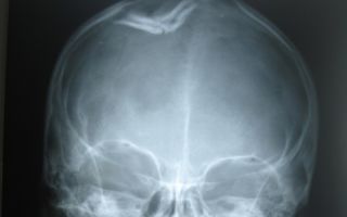 Перелом черепа у грудничка: причины и виды повреждений, внешние признаки и основные симптомы, правила оказания первой помощи и лечебные мероприятия, осложнения и прогноз