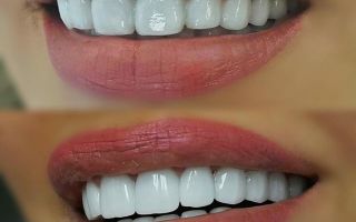 Виниры на зубы (зубные накладки): что это, как делают винирование зубов, виды, срок службы, фото до и после