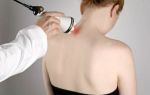 Миозит мышц спины (воспаление мышц): причины, характерные симптомы, лечение народными и медицинскими средствами