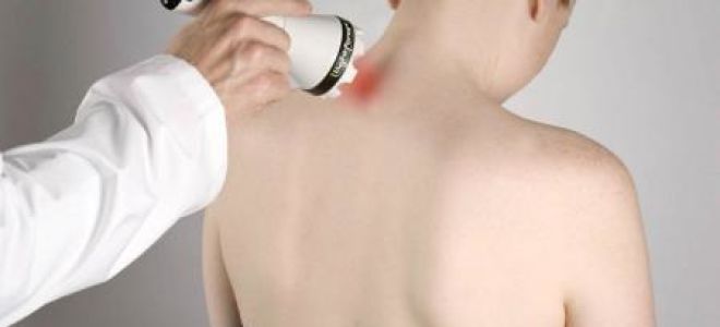 Миозит мышц спины (воспаление мышц): причины, характерные симптомы, лечение народными и медицинскими средствами