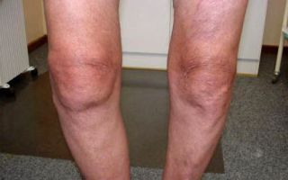 Гонартроз коленного сустава 1 степени: современные методы терапии и применение компрессов, методы физиотерапии, клиническая картина и признаки патологии