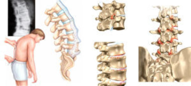 Артрит позвоночника: признаки и причины патологии, клиническая картина и разновидности болезни, лечебные мероприятия и профилактика