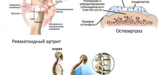Аналоги лекарства ортофен: описание, состав и цена в аптеке, дешевые российские и зарубежные заменители, показания к назначению