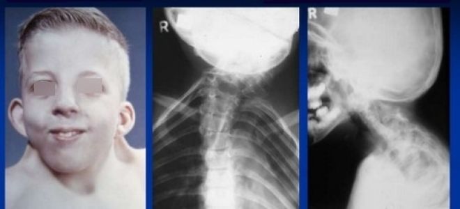 Синдром клиппеля-фейля: особенность патологии и причины ее развития, характерные симптомы и диагностика, методы лечения и возможные осложнения, прогноз для жизни