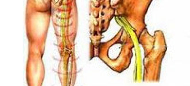 Неврит седалищного нерва: причины развития заболевания, клиническая картина и методы диагностики, лечение медикаментами и полезные физиотерапевтические мероприятия
