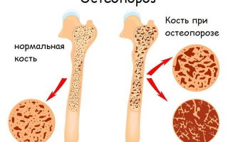 Остеопороз плечевого сустава: причины и признаки заболевания, медикаментозные и физические методы лечения, народные рецепты для борьбы с недугом