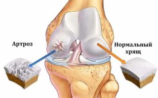 Народные средства при артрозе коленного сустава: рецепты нетрадиционной медицины, способы их применения и противопоказания к использованию