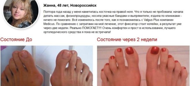 Корректор valgus plus (вальгус плюс) для большого пальца: что собой представляет, показания и противопоказания для использования, обоснование лечебного действия и отзывы покупателей, инструкция по применению