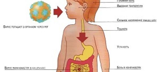 Причины, симптомы, диагностика и лечение ротавируса у детей