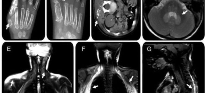 Прогрессирующая оссифицирующая фибродисплазия: характеристика заболевания, симптомы и клиническая картина, как развивается и как лечить, осложнения и последствия