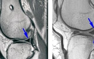 Артроскопия коленного сустава: что это такое, техника выполнения операции