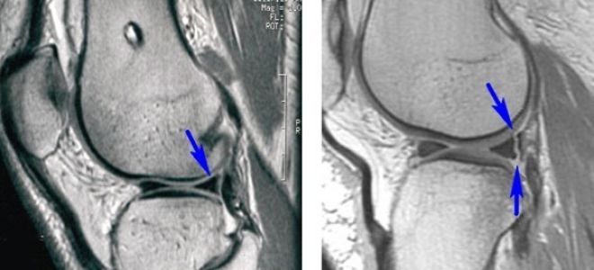Артроскопия коленного сустава: что это такое, техника выполнения операции