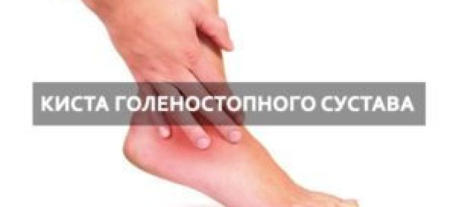 Киста голеностопного сустава: причины появления новообразования, характерные симптомы и методы диагностики, консервативные и народные способы лечения, показания к операции
