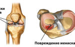 Последствия удаления мениска коленного сустава: показания к операции и виды вмешательства, особенности реабилитации и сроки восстановления, осложнения