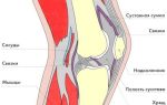 Воспаление связок коленного сустава: причины и характерные симптомы патологии, лечение препаратами и показания к операции, рецепты народной медицины и реабилитация