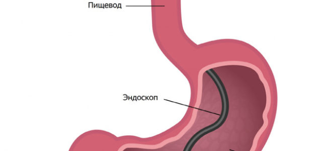 Гастрит с пониженной кислотностью: диагностика и методы лечения