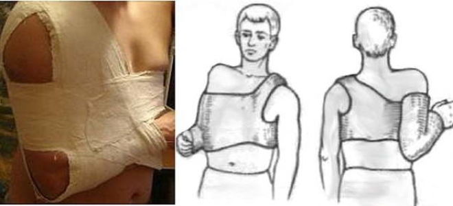 Ушиб ключицы: отличительные симптомы и методы диагностики, правила оказания первой помощи и особенности лечения, возможные осложнения и меры профилактики