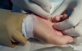 Щелкающий палец (стенозирующий лигаментит): признаки развития и клиническая картина, медикаментозная терапия и физиотерапия, стадии болезни