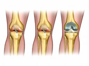 Эндопротезирование коленного сустава: подготовка, этапы операции и качественный реабилитационный период, профилактика осложнений и запрещенные виды деятельности