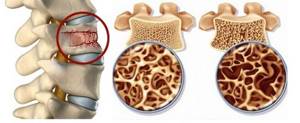 Остеопения и остеопороз — в чем разница заболеваний: почему кости слабеют, как восстановить, витамины, упражнения, рекомендации врачей,