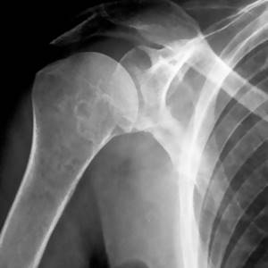 Рентген плечевого сустава: принцип исследования, показания и противопоказания, подготовка к диагностике и проведение, расшифровка результатов и полезные советы