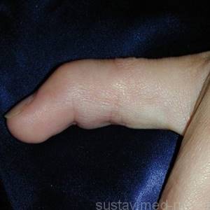Разрыв сухожилия на пальце руки: классификация и клиническая картина, сроки выздоровления и как лечить, возможные осложнения