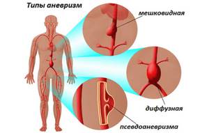 Спазмы в грудной клетке: основные причины резкой боли, сопутствующие симптомы и рекомендации по облегчению состояния, методы лечения и профилактики