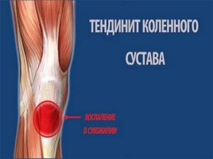 Боль в колене сбоку с внутренней стороны: причины развития патологии, как лечить болевой синдром, профилактика и возможные осложнения