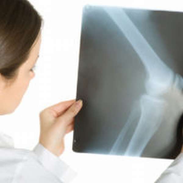 Остеосинтез при переломе кости: виды, показания и противопоказания метода, техника операции, осложнения после