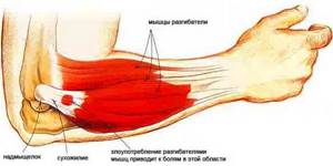 Боль в локтевом суставе с внешней стороны руки: признаки и особенности проявления, методы купирования болевого синдрома, принципы лечения и возможные патологии