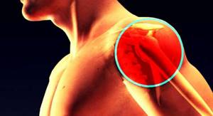 Остеохондроз плечевого сустава: чем опасно заболевание, как проявляется, диагностика, основные методы лечения медикаментозными препаратами и народными средствами
