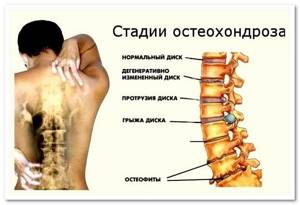 Ортопедический бандаж для спины: виды, различия по степени жесткости, производители, показания к использованию, принципы подбора приспособления