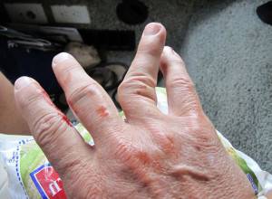 Вывих пальца на руке симптомы: пошаговая инструкция к первой помощи, как правильно вправить, лечение и профилактика