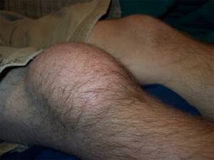 Бурсит коленного сустава: признаки и причины патологии, описание недуга и способы терапии, методы диагностики и прогноз на выздоровление