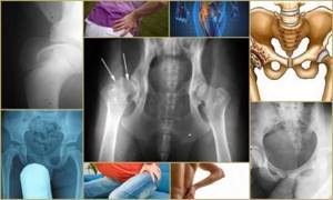 Остеохондроз тазобедренного сустава: причины и симптоматика патологии, клиническая картина и методики лечения заболевания, факторы риска