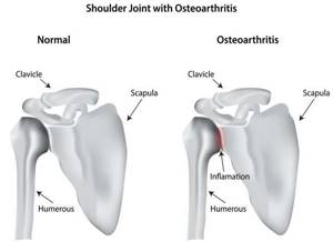Остеоартроз плечевого сустава: общее описание и стадии заболевания, симптомы и выявление патологии, препараты и физиотерапия, мануальная терапия и оперативное вмешательство