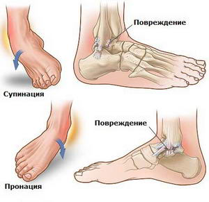 Почему болят ступни ног по утрам при наступании: основные причины, симптомы, способы диагностики и методы лечения